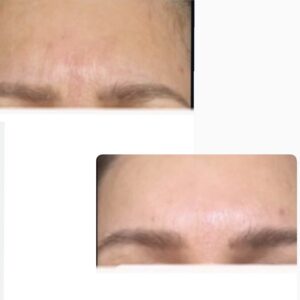 массаж лица до и после результат омоложения