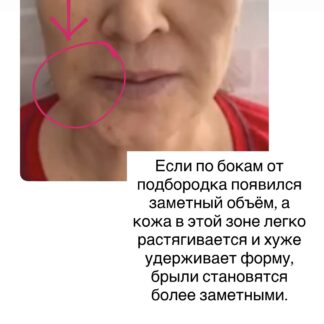 Массажная техника «Мастер глубокой коррекции»- брыль