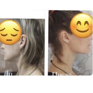 массаж лица до и после результат омоложения