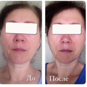 массаж лица до и после результат омоложения