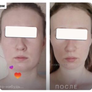 массаж лица до и после результат омоложения