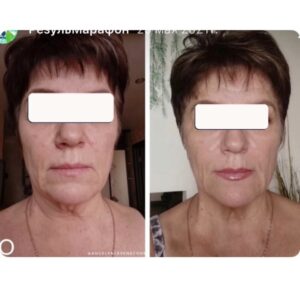 массаж лица до и после результат омоложения