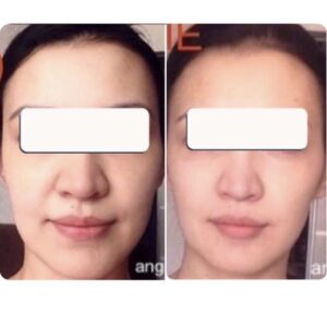 массаж лица до и после результат омоложения