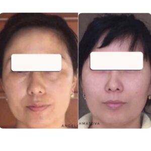 массаж лица до и после результат омоложения