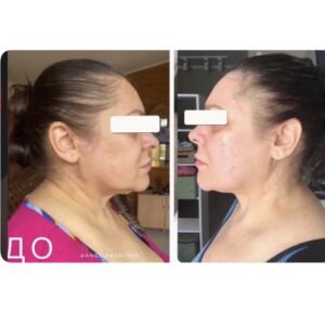 массаж лица до и после результат омоложения